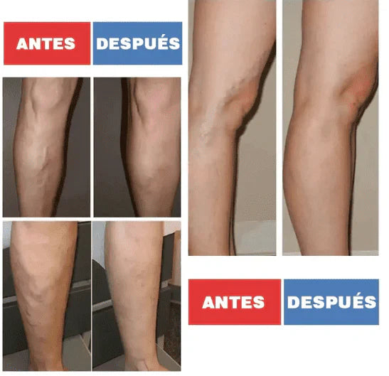 Packs de parches para eliminar las varices - Envío Gratis